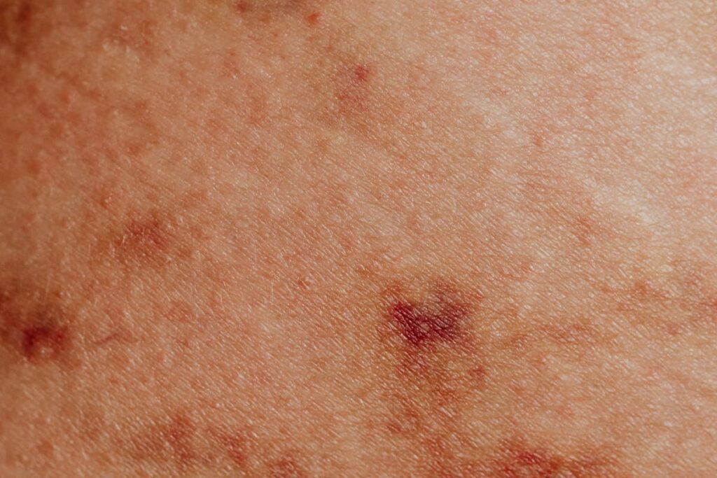 Can Generalized Postural Psoriasis Be a Reason for SSDI Benefits?
