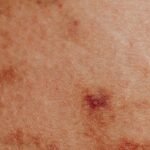 Can Generalized Postural Psoriasis Be a Reason for SSDI Benefits?