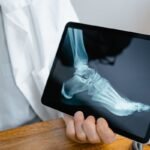 ankle sprain vs break